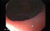 Early Gastric Cancer - Endoscopy (5 of 21)