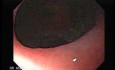Early Gastric Cancer - Endoscopy (5 of 21)