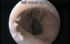 Nose: Foreign Body 