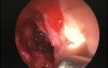 Anterior Wall Sphenoid Sinusotomy - Endoscopy