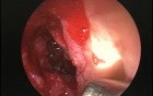 Anterior Wall Sphenoid Sinusotomy - Endoscopy