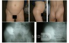 Ewings Sarcoma of iliac bone