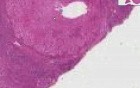 Wilson disease