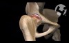 Future Hip Replacement
