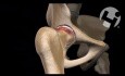 Future Hip Replacement