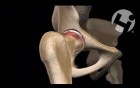 Future Hip Replacement