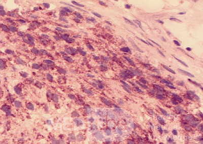 Gastrointestinal Stromal tumor (GIST) (65 of 65)
