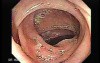 Sigmoid Diverticulitis - Colovesical Fistula (3 of 8)