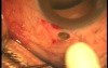 Glaucoma surgery