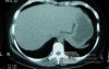 Esophagus - Pneumatic Dilation for Achalasia (27 of 31)