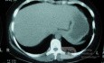 Esophagus - Pneumatic Dilation for Achalasia (27 of 31)