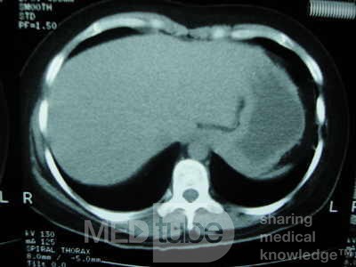 Esophagus - Pneumatic Dilation for Achalasia (27 of 31)