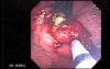 Upper Gastrointestinal Tract - Bleeding (6 of 7)