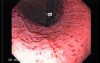 Acute Gastritis (Pangastritis) (6 of 10)