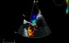 Rheumatic Disease