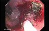 Tubulo - Villous Rectal Adenoma - Endoscopy (12 of 35)
