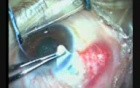 Trabeculectomy With MMC 