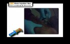 Intraosseous Injection With Bone Injection Gun (BIG)
