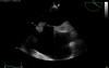 Lipomatous Hypertrophy of the Atrial Septum (LHAS) - Video nr 2