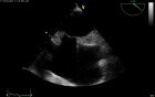 Lipomatous Hypertrophy of the Atrial Septum (LHAS) - Video nr 2