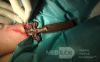 Foreign Body In Gluteal Region.