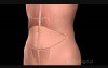 TRAM Breast Reconstruction