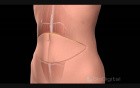 TRAM Breast Reconstruction