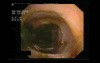 Colonoscopic View Of Large Bowel In Generalized CMV Infection