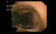 Colonoscopic View Of Large Bowel In Generalized CMV Infection