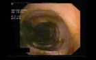 Colonoscopic View Of Large Bowel In Generalized CMV Infection