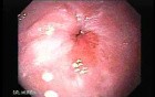 Achalasia - Tight Gastroesophageal Junction