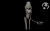 Open Reduction Internal Fixation of Left Tibial Plateau and Shaft Fracture