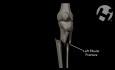 Open Reduction Internal Fixation of Left Tibial Plateau and Shaft Fracture