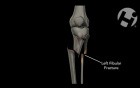 Open Reduction Internal Fixation of Left Tibial Plateau and Shaft Fracture