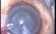 Combined Surgery Phacoemulsification And Trabeculectomy