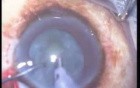 Combined Surgery Phacoemulsification And Trabeculectomy