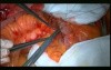 Open Right Hemicolectomy – Technical Principles - Operation No 1 - Part 5