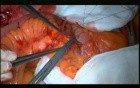 Open Right Hemicolectomy – Technical Principles - Operation No 1 - Part 5