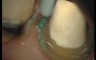 Procedure Of Final Preparation 11 - 15 (2/3)