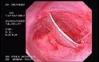 Zollinger- Ellison Syndrome - Gastric Ulcer with Gastrocolic Fistula (10 of 21)