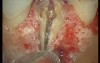 Complicated Extraction Of Tooth 11 (2/2)