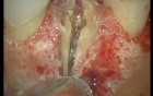 Complicated Extraction Of Tooth 11 (2/2)