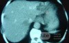 ScirrhousGastric Carcinoma (Linitis Plastica) (12 of 15)