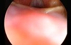 Acute subepithelial haemorrhage