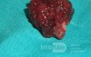 Giant Multilobulated Gastric Polyp (20 of 20)