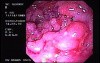 Severe Case Of Ulcerative Colitis (6 of 6)