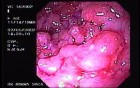 Severe Case Of Ulcerative Colitis (6 of 6)