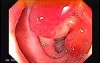 Endoscopic View Of Diverticulitis Of The Sigmoid (1 of 4)