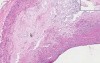 Coronary Arteries - Atherosclerosis