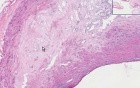 Coronary Arteries - Atherosclerosis
